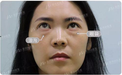 去泪沟视频,揭秘高效去泪沟视频教程